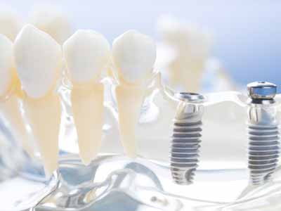 zahn-implantat-fest-sitzender-zahnersatz-zahnarzt-berlin