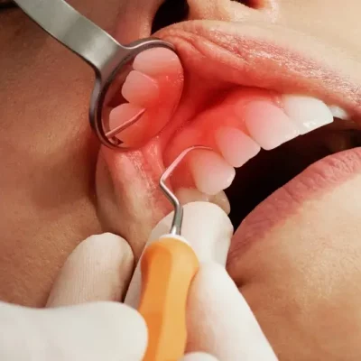 parodontitistherapie-zahnfleisch-entzuendung-zahnarzt-schriesheim